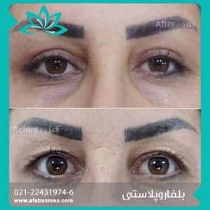 belfaroplasty