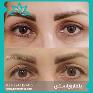 belfaroplasty2