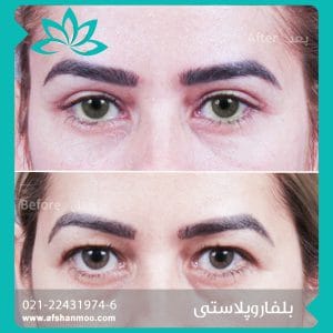 belfaroplasty3