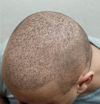 after-the-best-hair-transplant-in-tehran