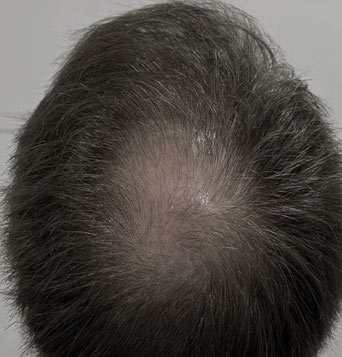 before-the-best-hair-transplan-of-tehran