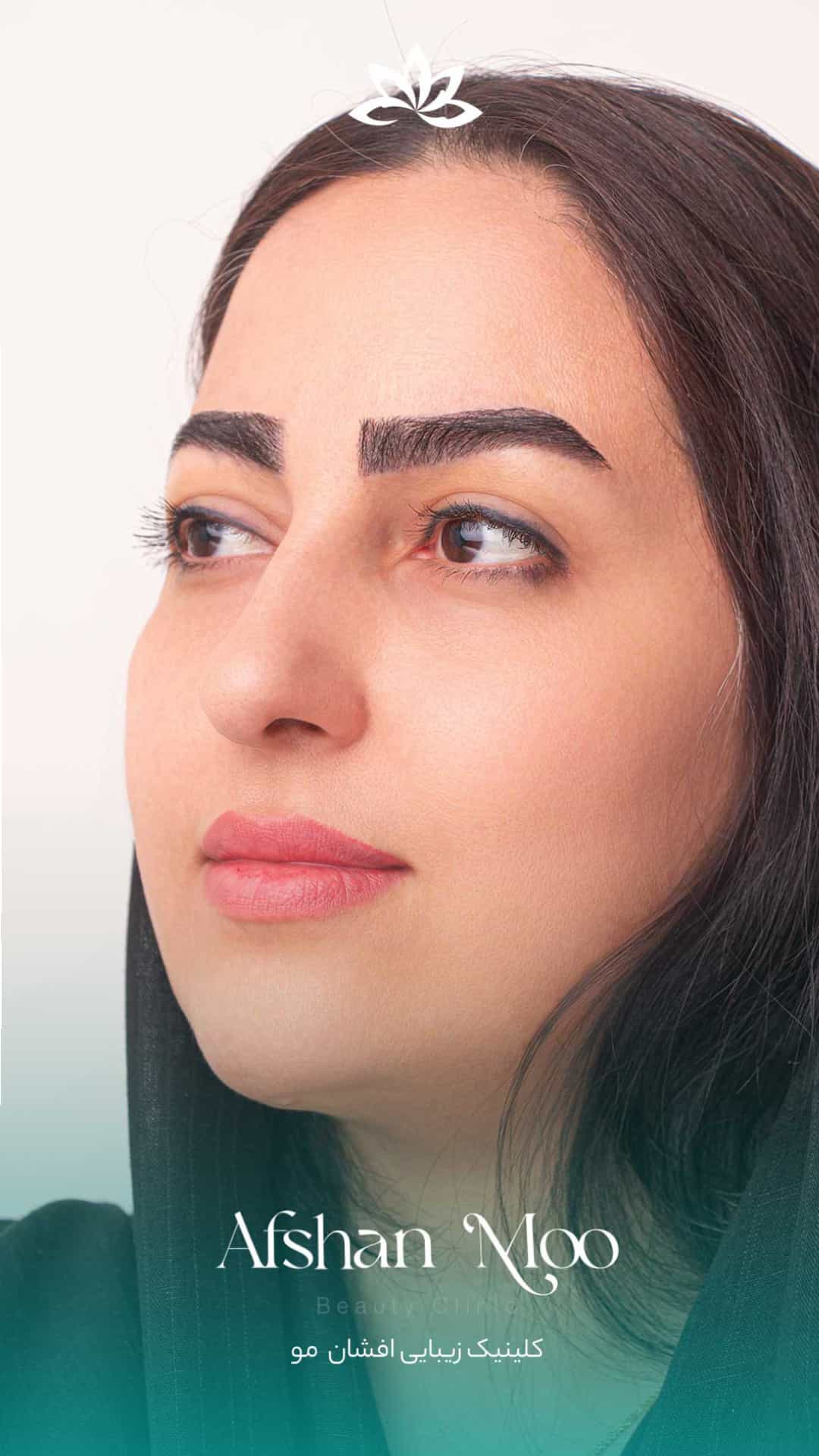 عکس کاشت ابرو بدون جراحی در افشان مو